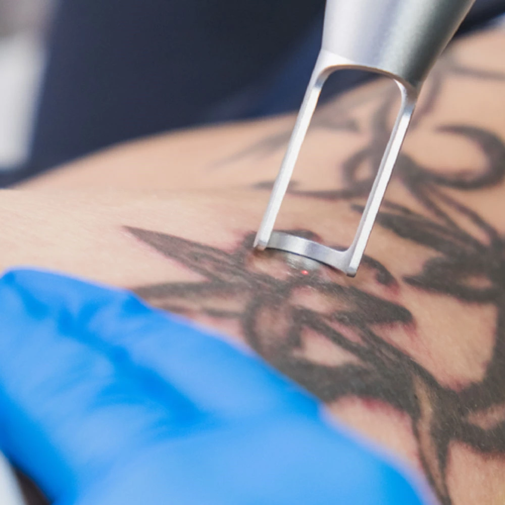 Eliminación de tatuajes: opciones y resultados